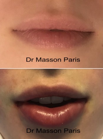 Plastic Surgery In France